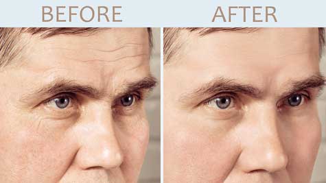 Man after successful microneedling to remove wrinkles