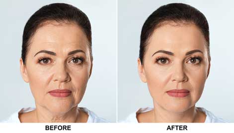 PRP facial and Lift on a female patient